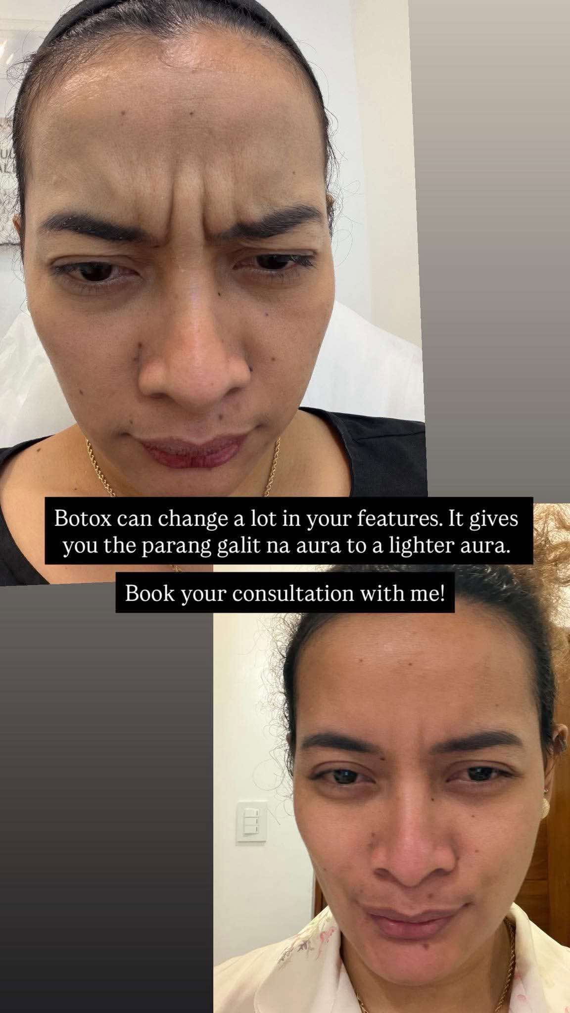 Botox result